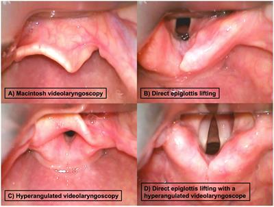 Hyperangulated blades or direct epiglottis lifting to optimize glottis visualization in difficult Macintosh videolaryngoscopy: a non-inferiority analysis of a prospective observational study